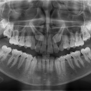 impacted teeth